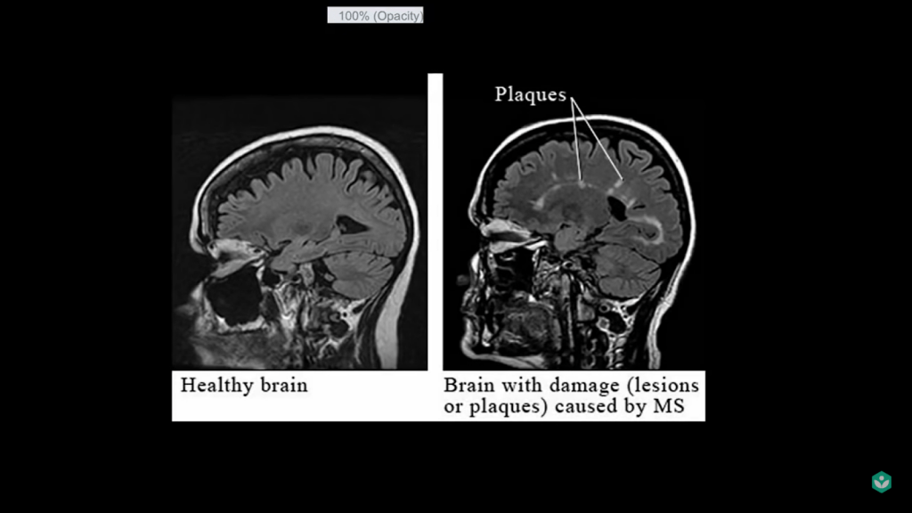 multiple sclerosis 5 facts brain damage