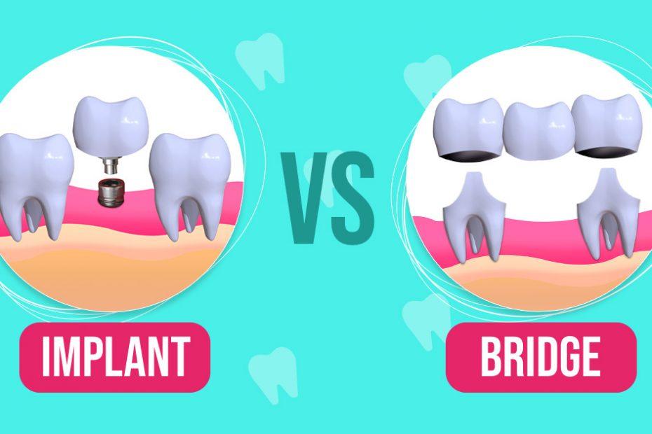 Dental Implant Vs Bridge – Which Is Better?