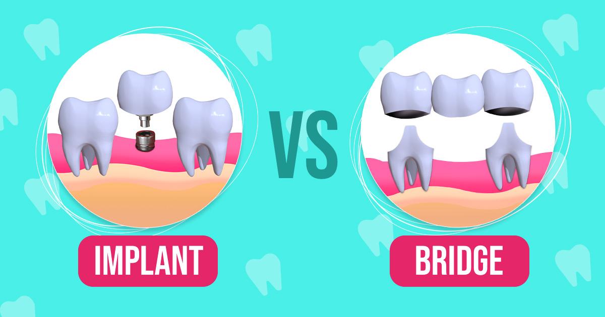 Dental Implant Vs Bridge – Which Is Better?