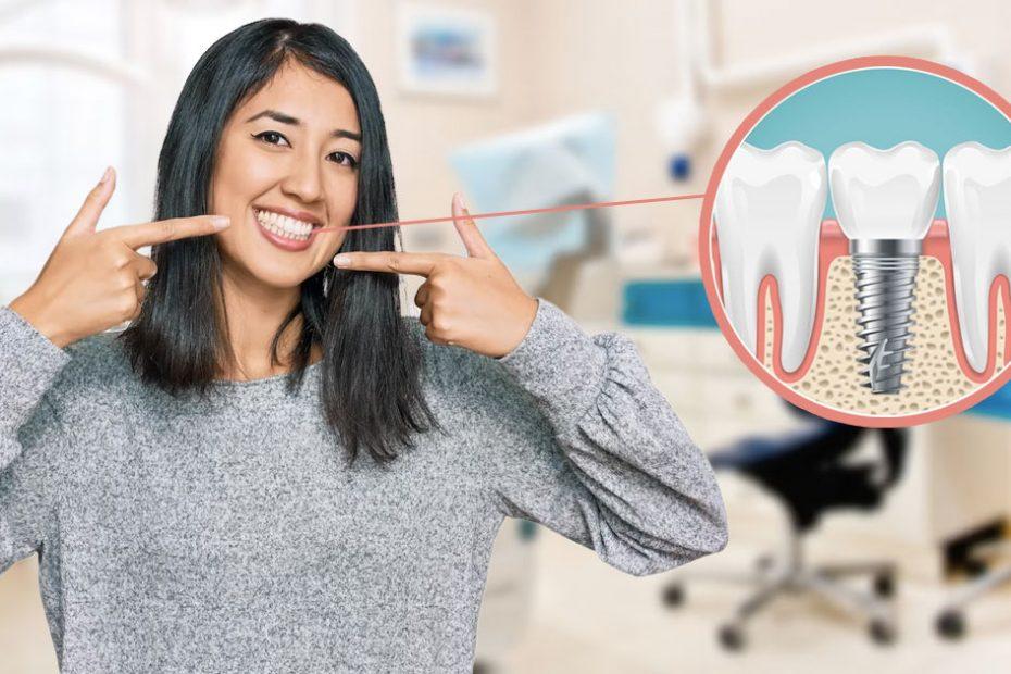 dental-implants-are-necessary