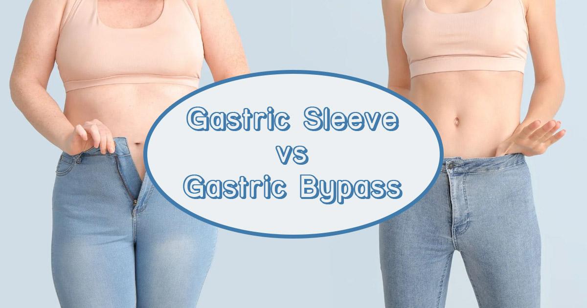 Gastric Bypass Vs Gastric Sleeve Whats The Difference 9581