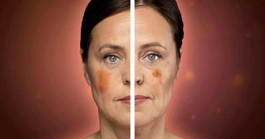 age spots vs melanoma