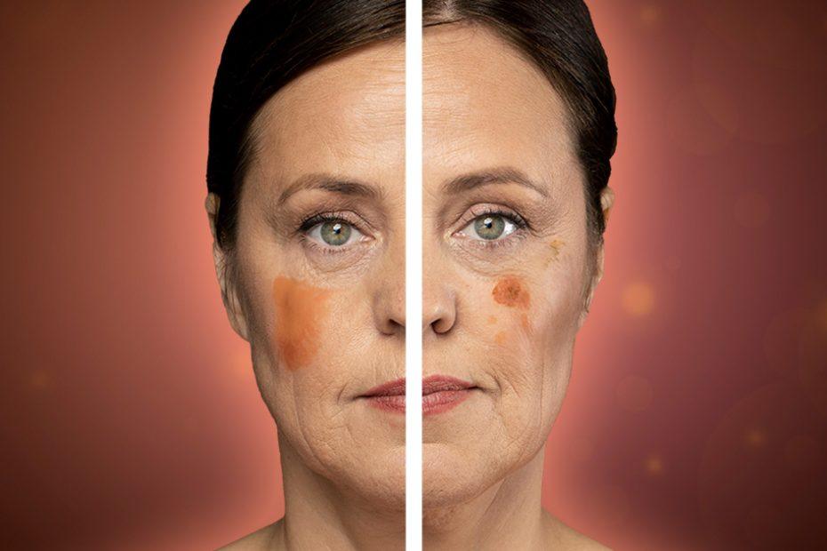 age spots vs melanoma