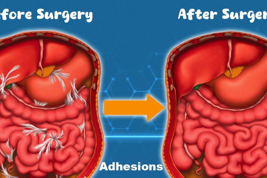 lysis-of-adhesions-procedure