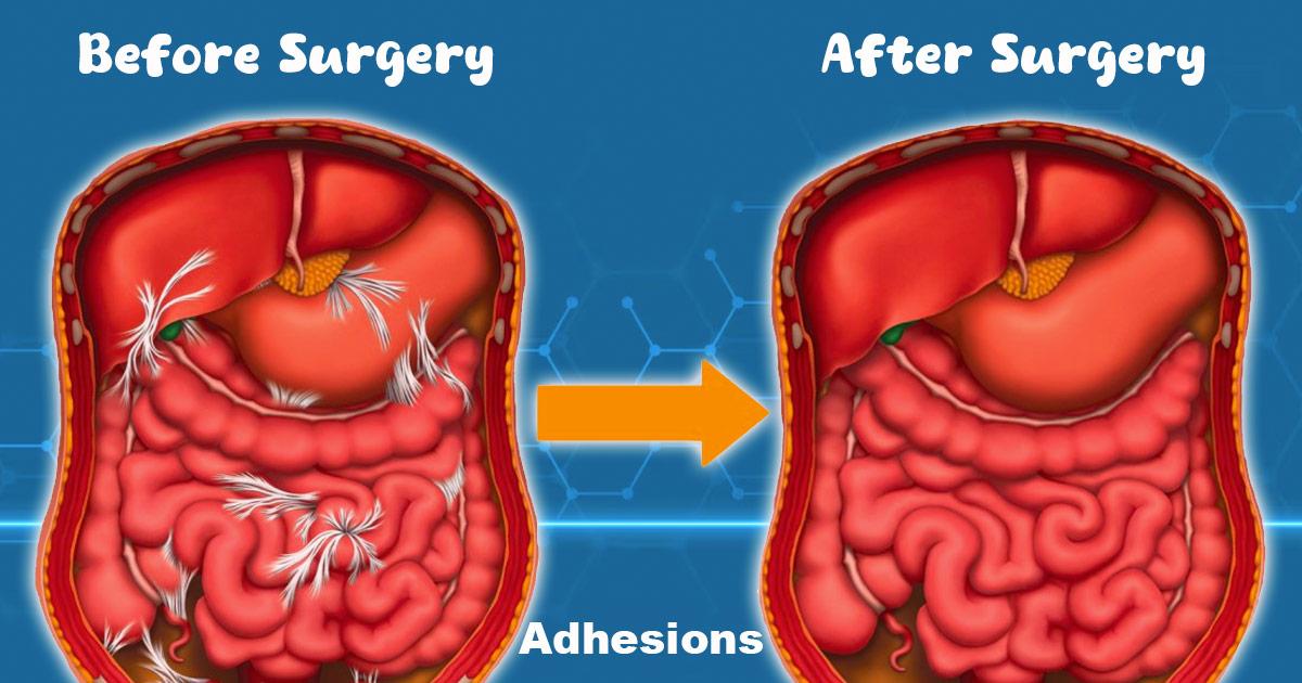 Understanding Lysis of Adhesions for Abdominal Pain