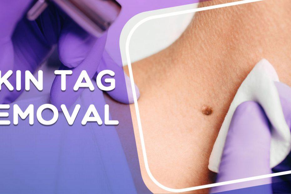 skin tag removal