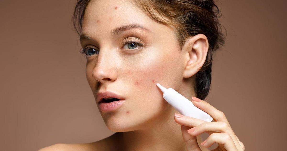 the-correct-way-to-apply-and-use-acne-spot-treatment