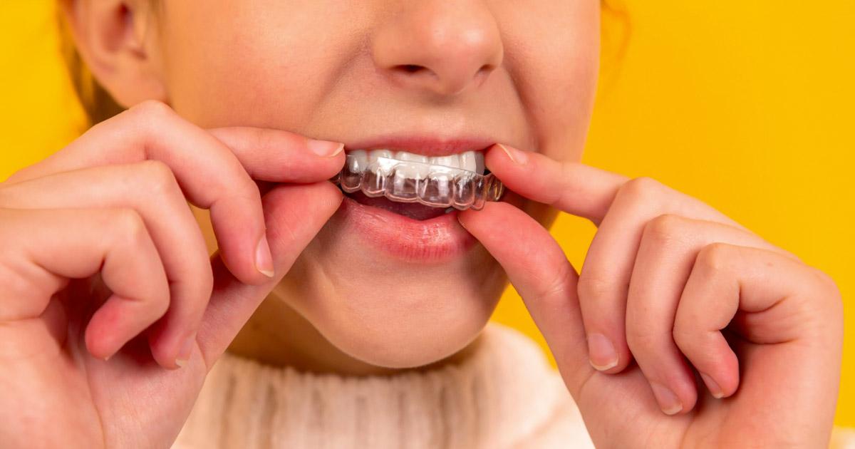 Splint for TMJ Treating TMD & Reducing Symptoms