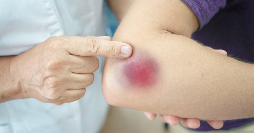 bruise-treatment