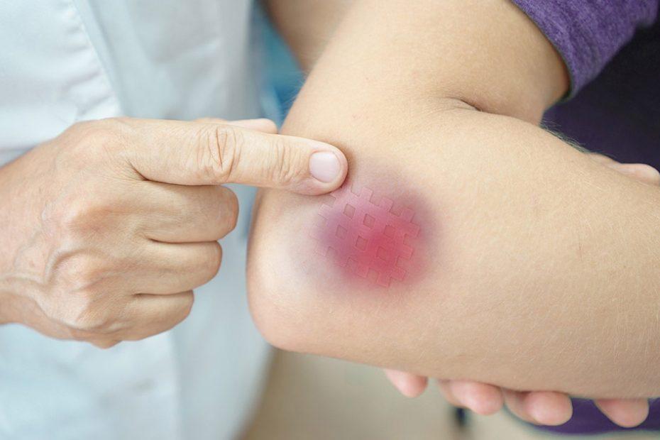 bruise-treatment