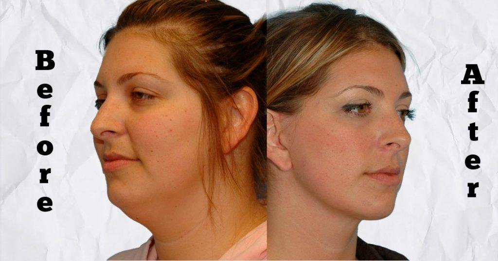 what is a mini neck lift