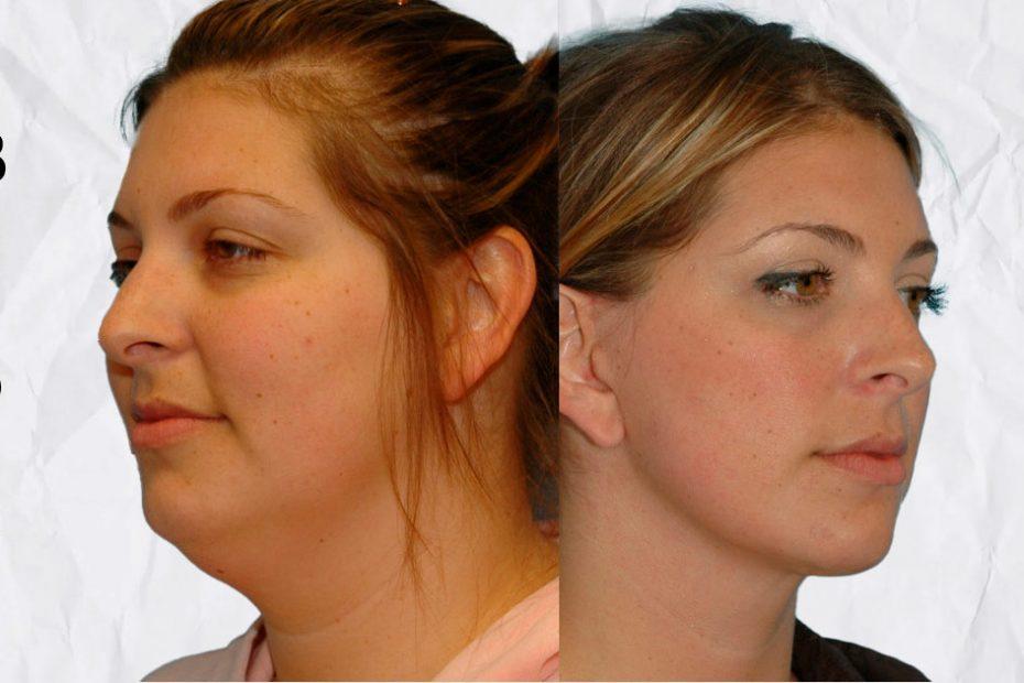 what is a mini neck lift