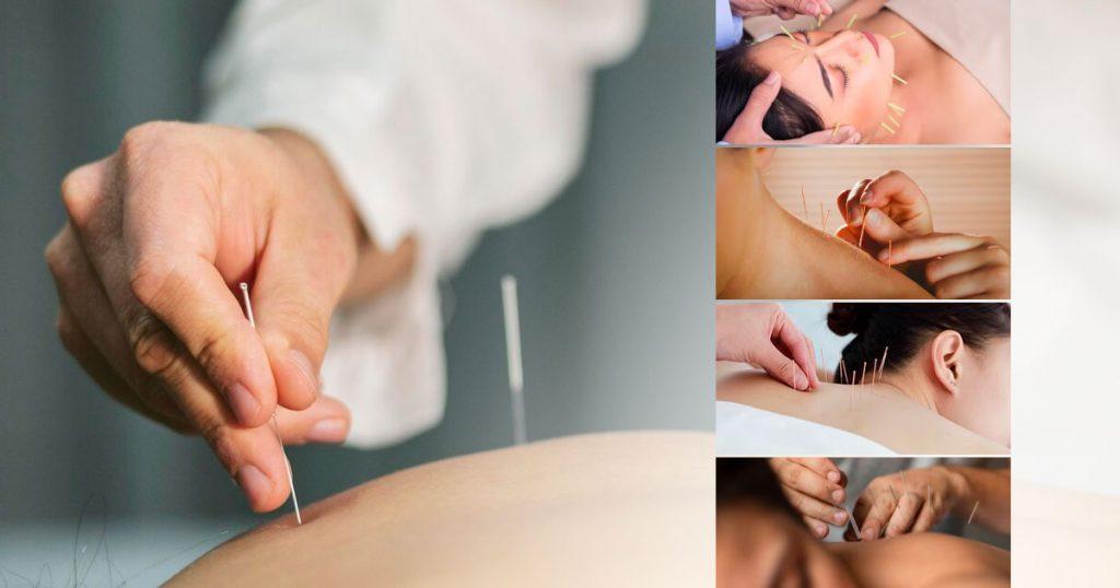 how often to do acupuncture