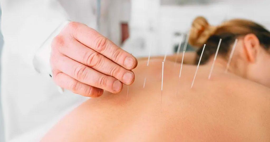 acupuncture-for-back