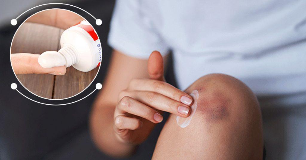 how to get rid of bruises with toothpaste