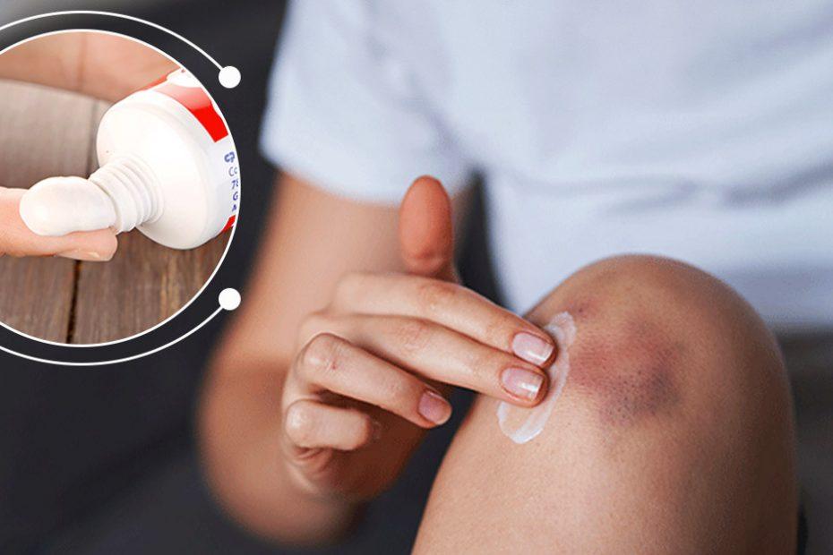 how to get rid of bruises with toothpaste