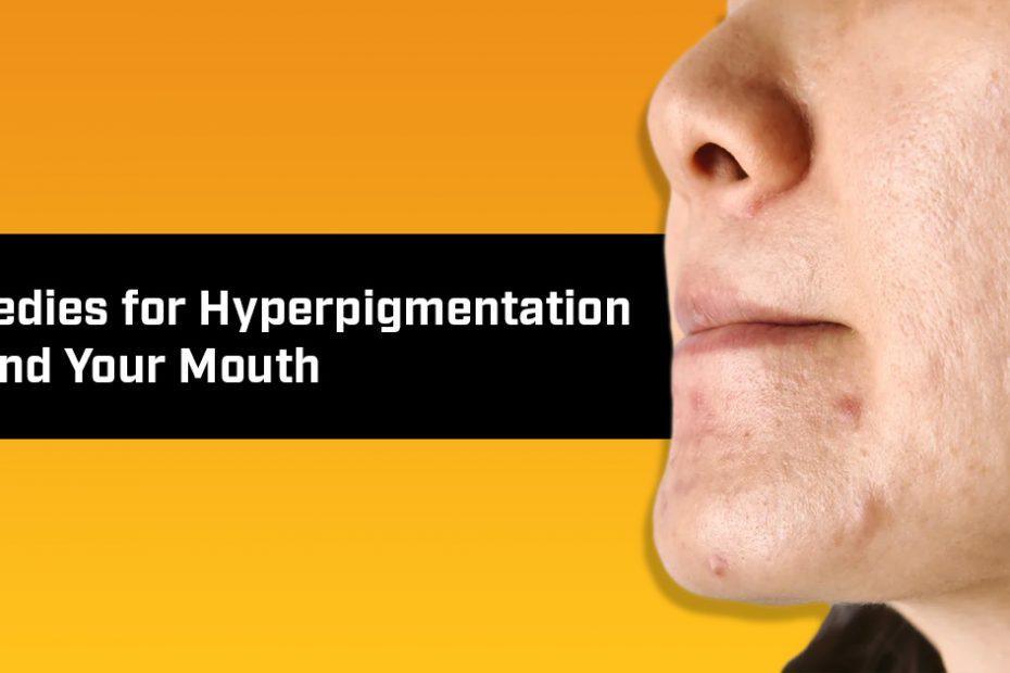 hyperpigmentation around mouth