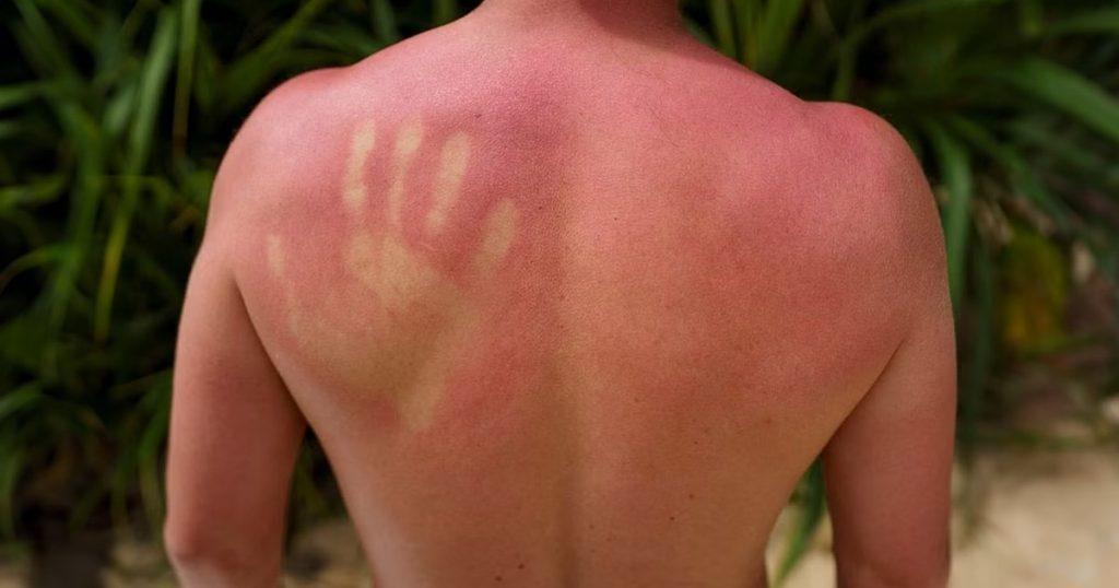 sun-poisoning-and-sunburn
