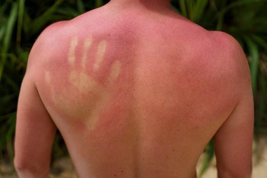 sun-poisoning-and-sunburn