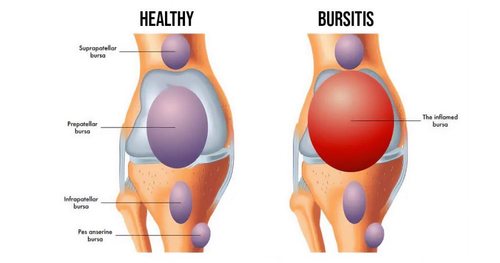 arthritis vs bursitis relief