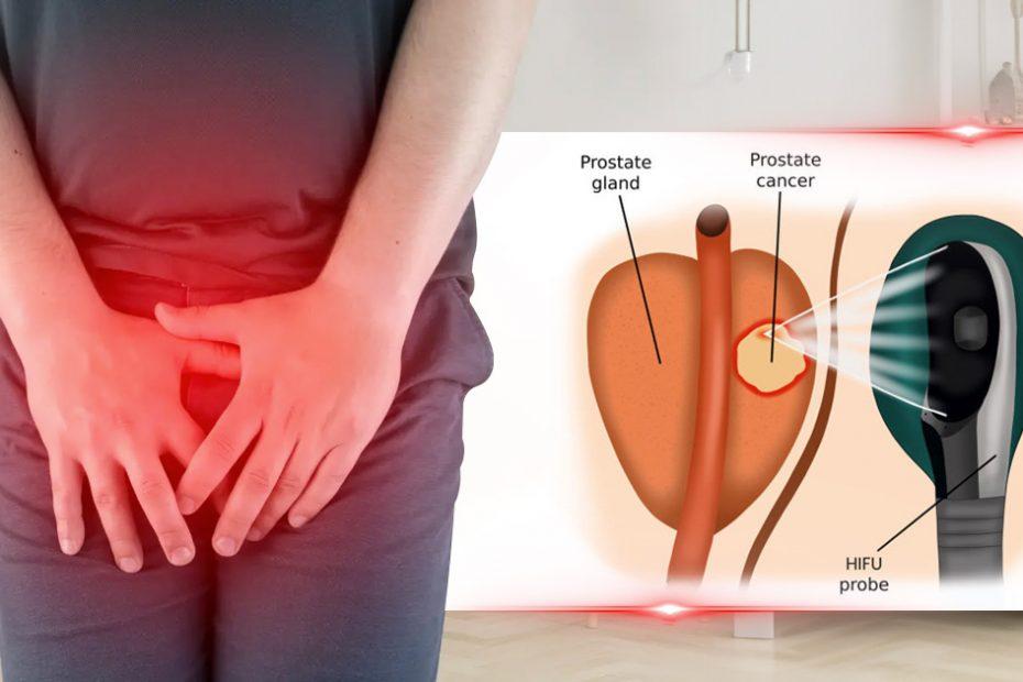 hifu prostate cancer