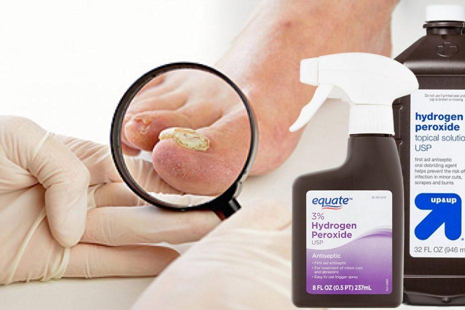 hydrogen peroxide for toenail fungus