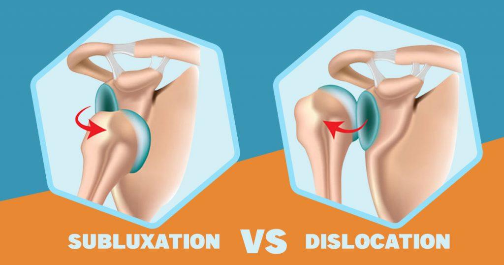 subluxation vs dislocation