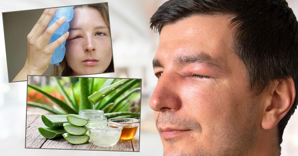 Eyelid Swelling from Bug Bite What to Do