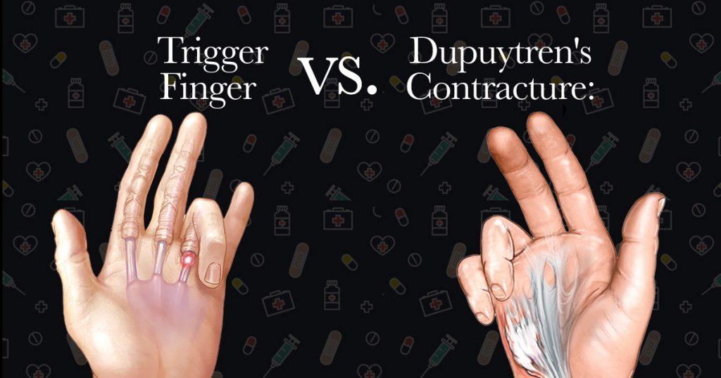 trigger-finger-vs-dupuytren's-contracture