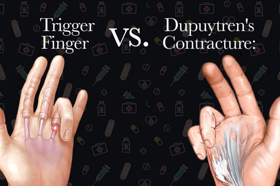 trigger-finger-vs-dupuytren's-contracture