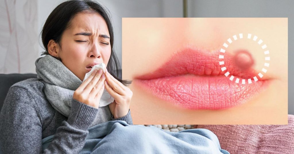 cold sores and stds