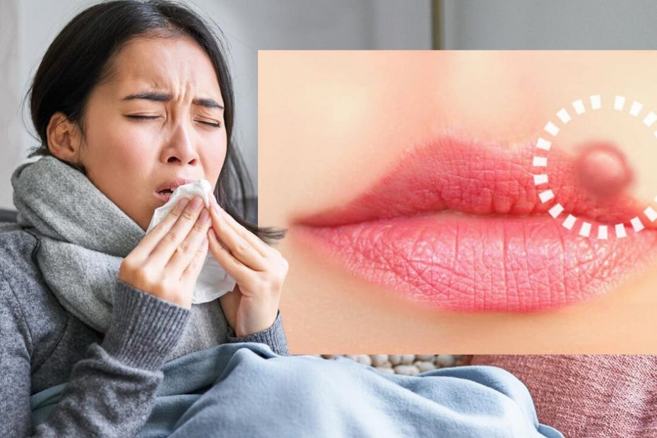 cold sores and stds