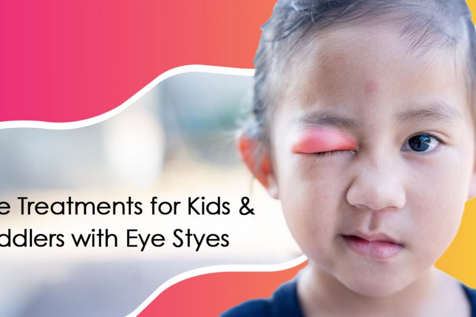 stye treatment for kids