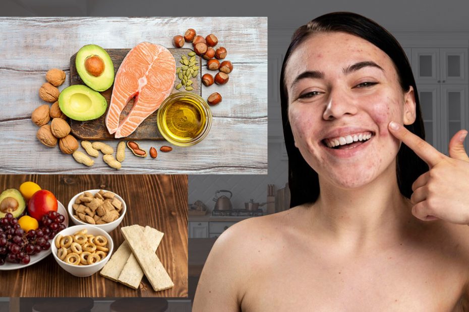 anti-acne-diet