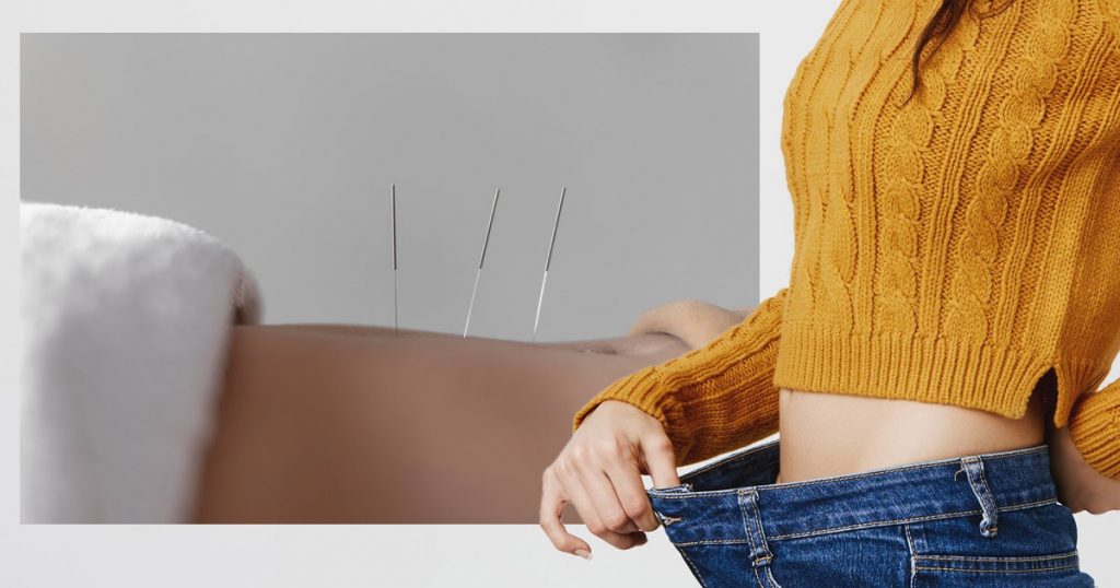 acupuncture for weight loss