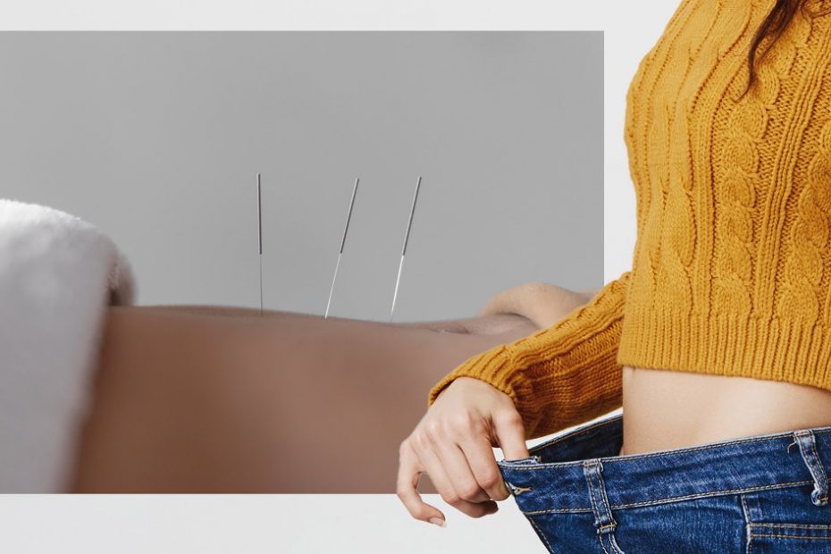 acupuncture for weight loss