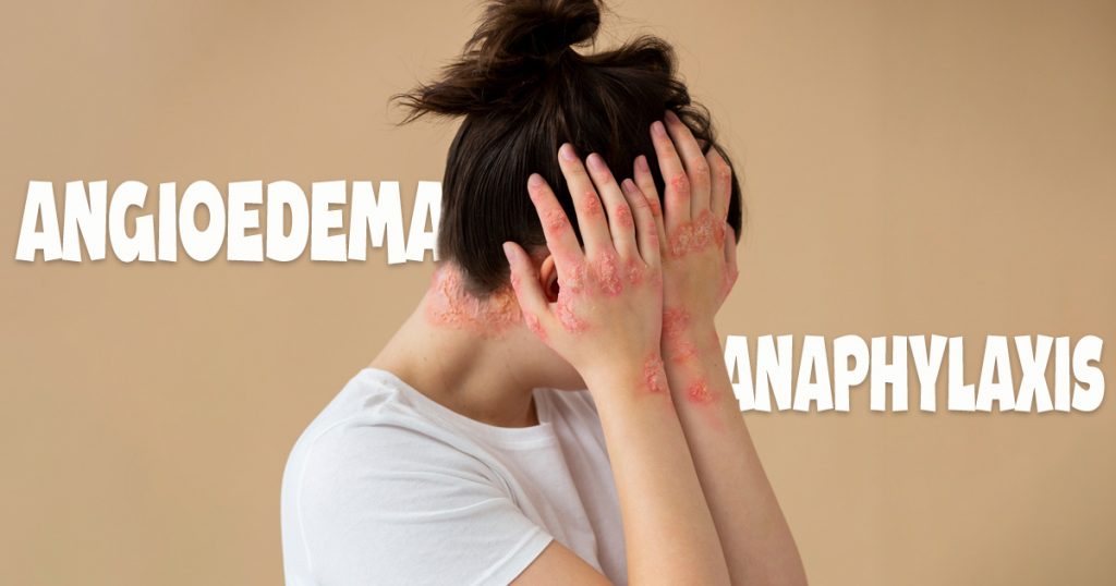 angioedema vs anaphylaxis