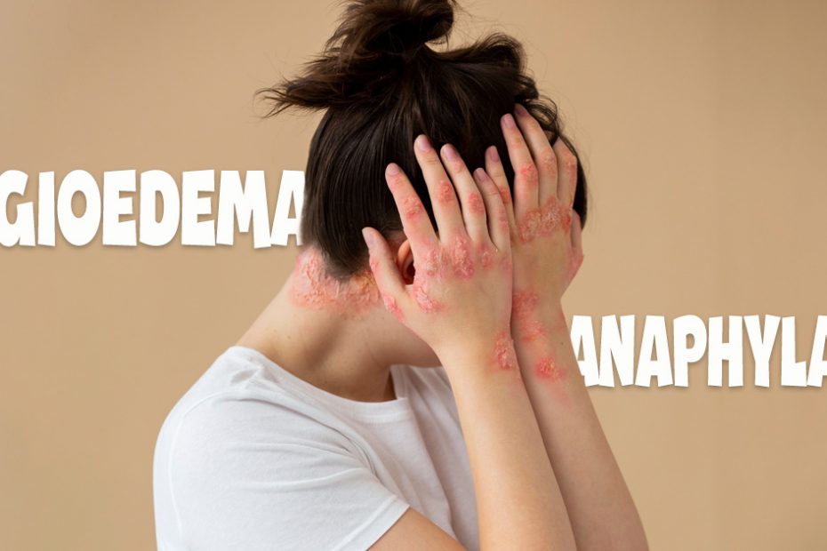 angioedema vs anaphylaxis