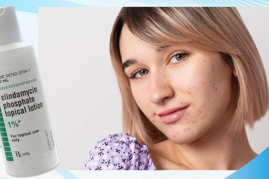 clindamycin-for-acne