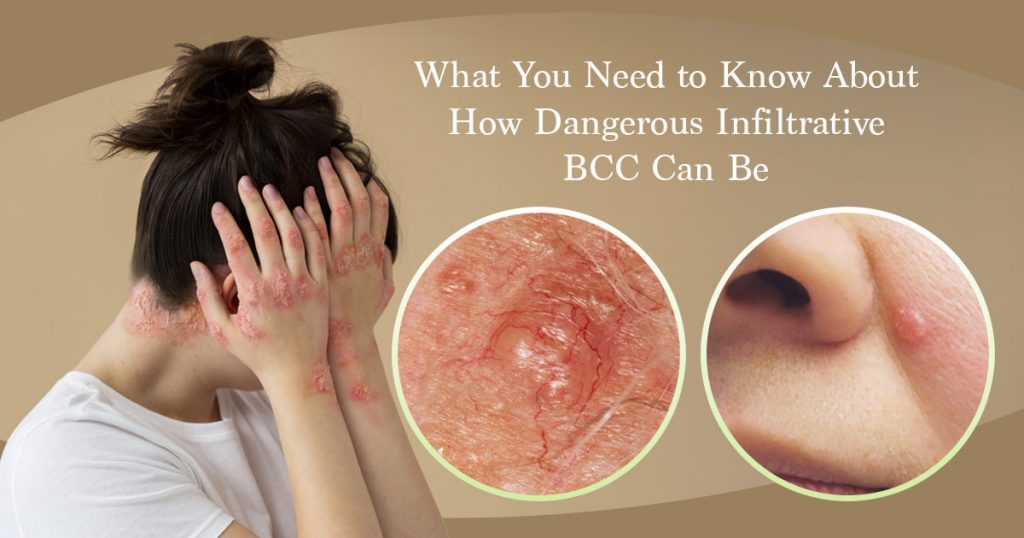 how dangerous infiltrative bcc