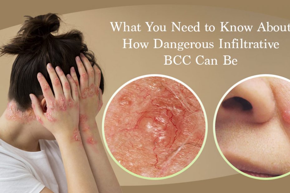 how dangerous infiltrative bcc