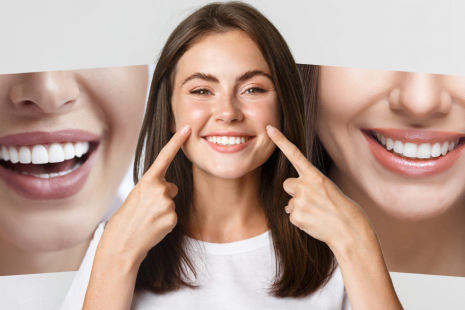 veneers-vs-lumineers