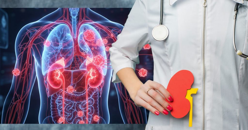 What are the chances of kidney cancer spreading